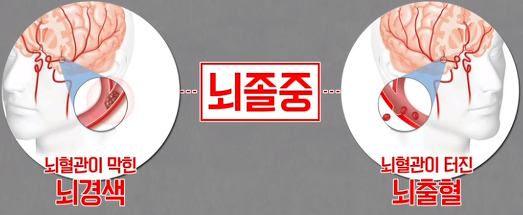  뇌경색 뇌출혈 전조증상 초기증상 후유증 (좋은 음식과 영양제)