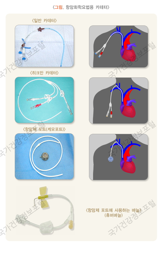 케모포트