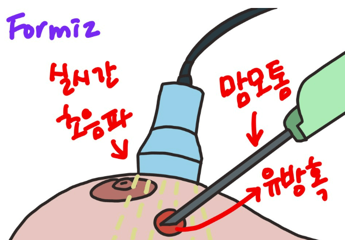 맘모톰 수술 비용 실비 맘모톰 후기(유방 섬유선종)