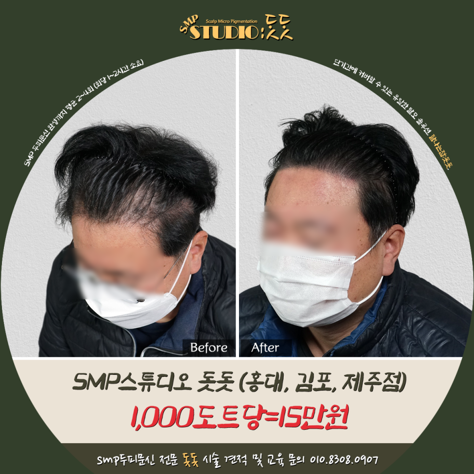  m자 탈모 엠자이마 모발이식하고도 모자라는 밀도 두피문신으로 보강