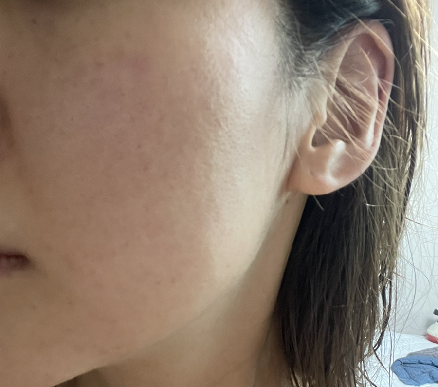 코조각주사 콧볼축소 효과 17