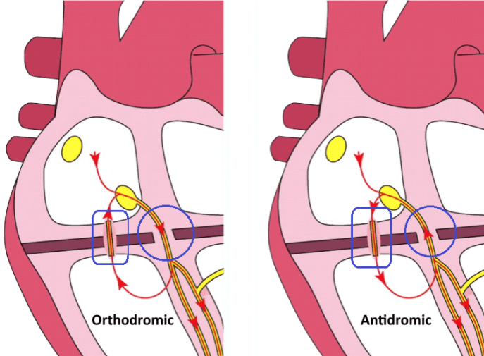 Orthodromic AVRT vs Antidromic AVRT