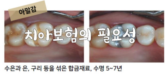  치아보험의 필요성: 치주질환과 통계,치주질환의 위험성에 대해 알아보아요!