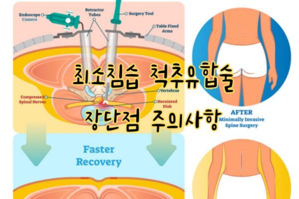 최소침습 척추유합술 장단점 주의사항