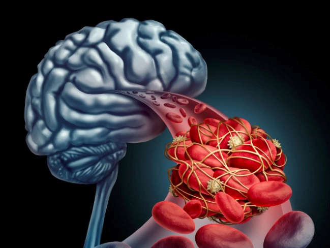 뇌출혈 초기증상 6가지 