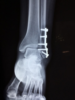 발목 골절 치료 : 엑스레이 사진