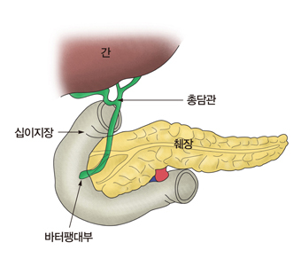 췌장암 초기증상