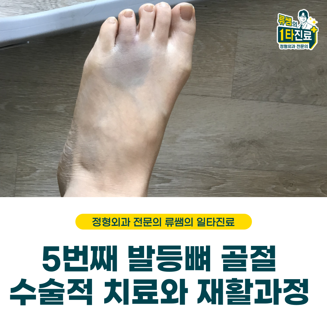  발등뼈 골절의 수술적 치료와 재활 과정