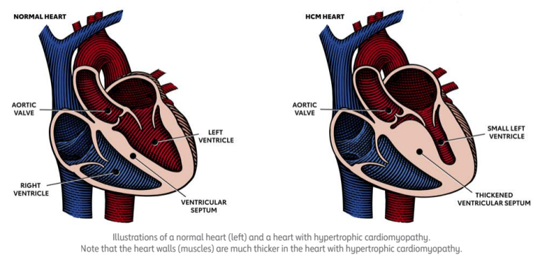 HCMP vs normal heart picture
