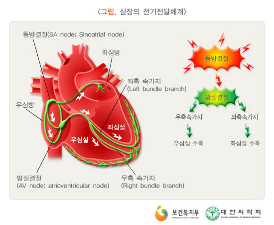 부정맥 사진