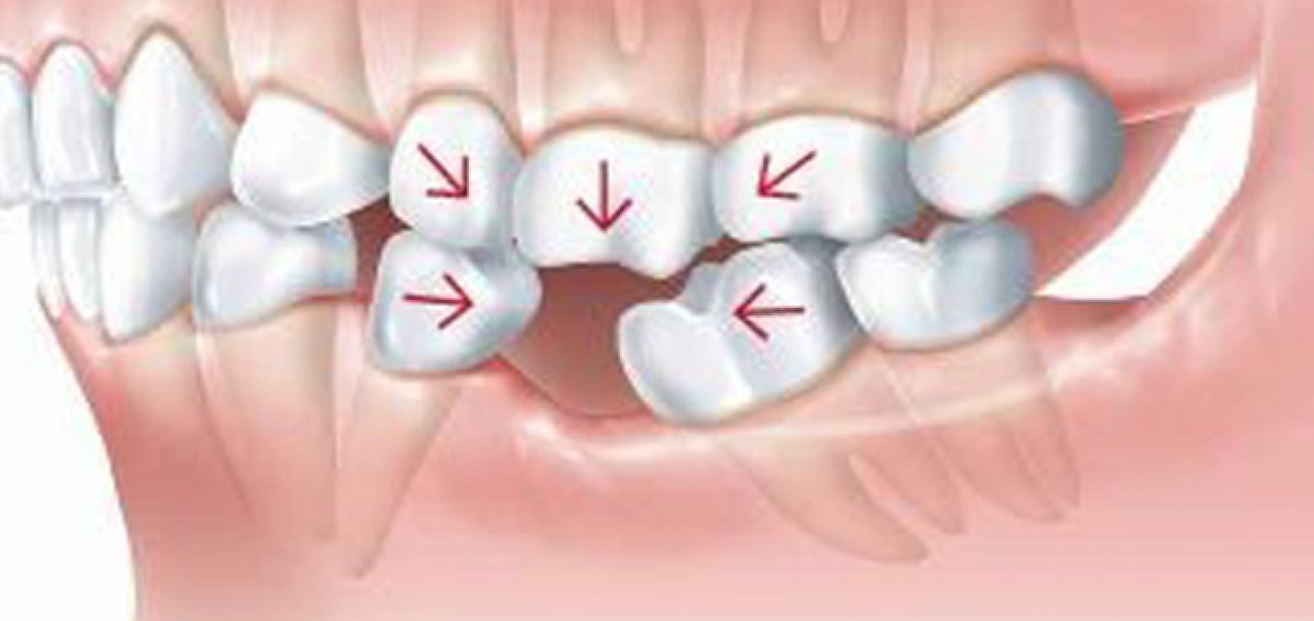 치아가 상실된 빈 공간으로 인접 치아들이 맹출되는 것을 나타낸 그림. 아래턱 치아가 빠졌을 때 양 옆 치아는 빈 공간으로 기울고 위쪽 치아는 중력으로 인해 내려앉거나 자동으로 빠짐