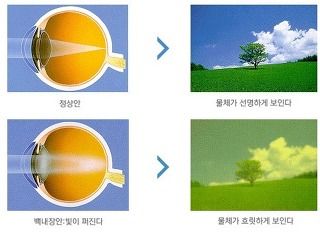 백내장 증상