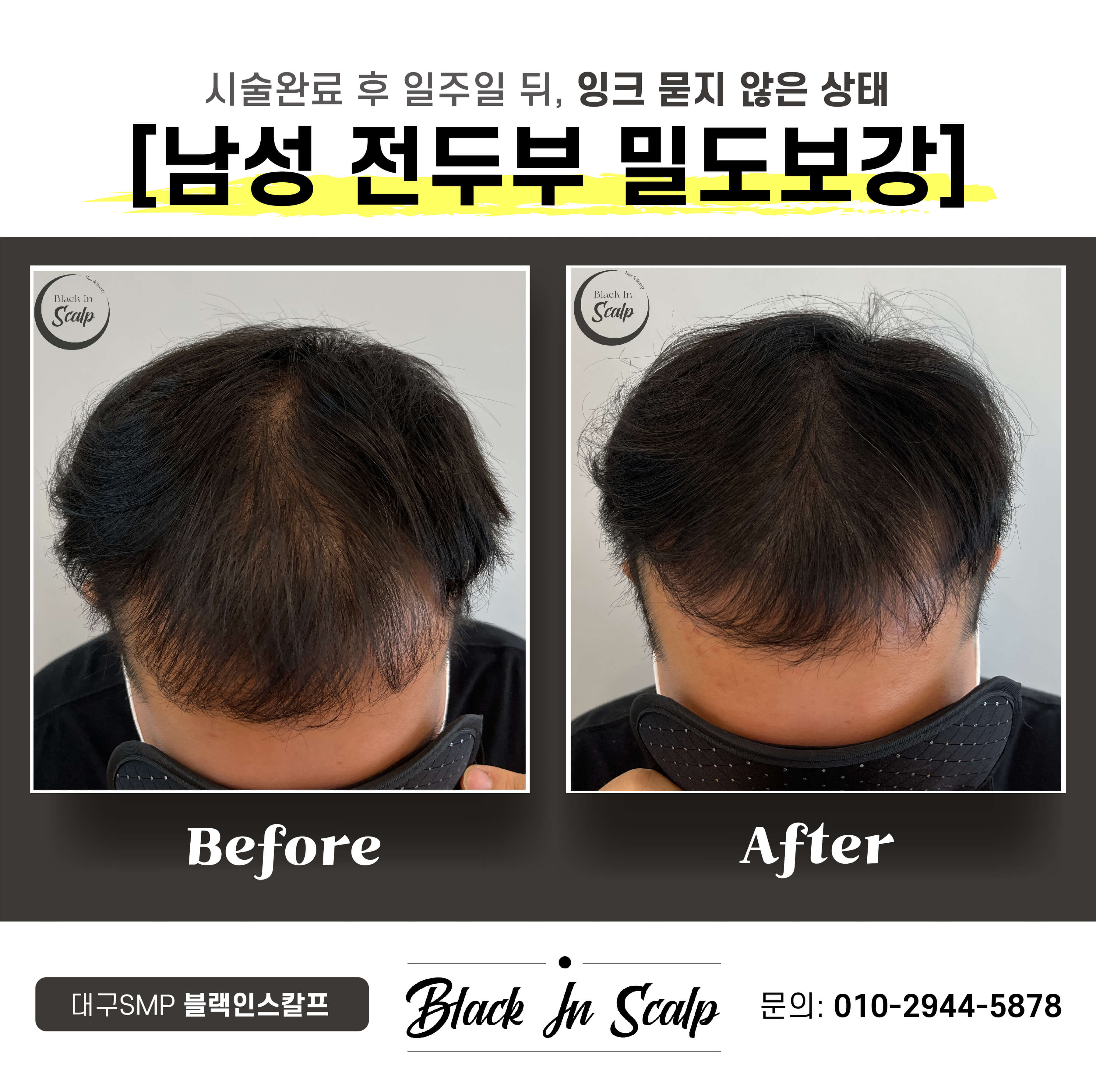 블랙인스칼프 이미지