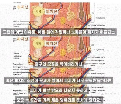  블랙헤드 제거 방법, 집에서 누구나 할 수 있는, 서울대 피부과 전문의, 클렌징오일 유의사항, 살리실산클렌저, 필링패드, 돈쓰지 말고 일단 집에서!