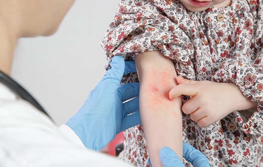  아토피 피부염 (Atopic Dermatitis) 원인 ,증상, 치료 방법