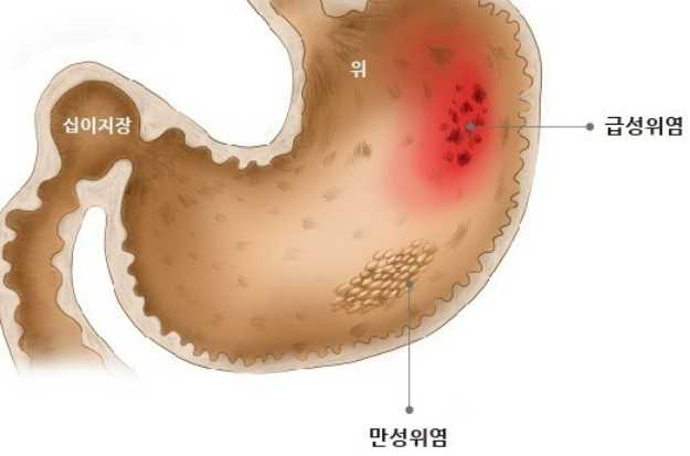 위염 - 왼쪽 갈비뼈 아래 통증