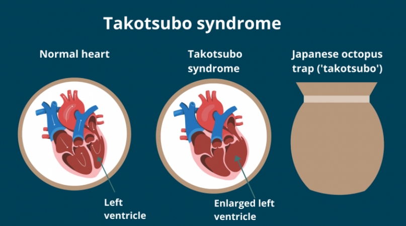  코로나19 백신, 타코츠보 심근병증 유발 VIDEO:Research: COVID-19 Vaccines May Trigger Takotsubo Cardiomyopathy