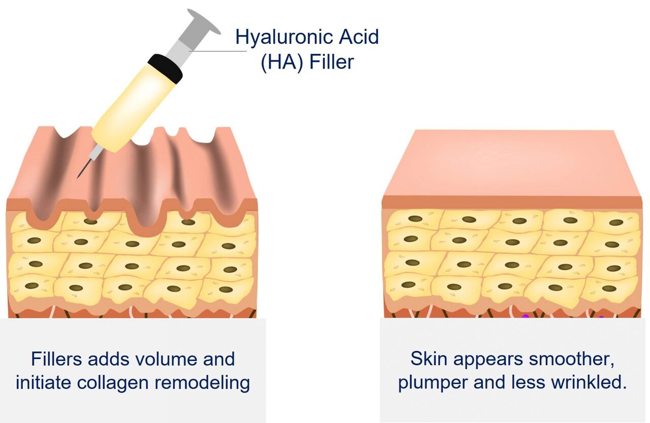 filler-collagen