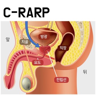 전립선암 초기증상 생존율 원인 수술방법 좋은음식