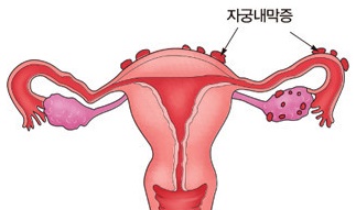  자궁내막증 원인 및 증상 알아봤습니다.