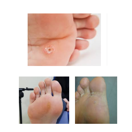  발바닥 티눈 원인 및 없애는법