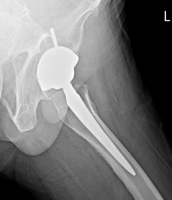 퇴행성 고관절염 환자 인공관절 치환술 후 X-ray