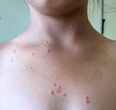 물방울모양 건선(guttate psoriasis)