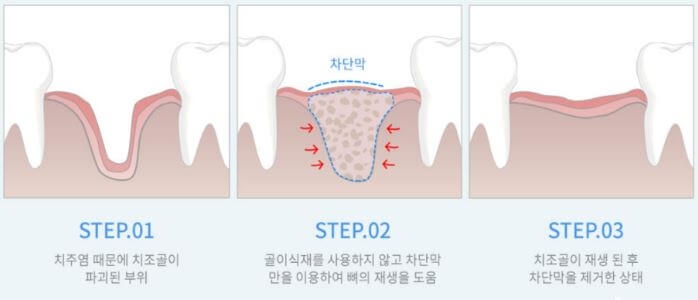 임플란트 뼈이식 비용