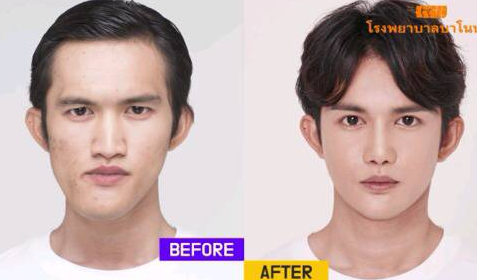 남자 코성형 전후 이렇게 달라진다고?? 남자 코성형 전후 이렇게 달라진다고??