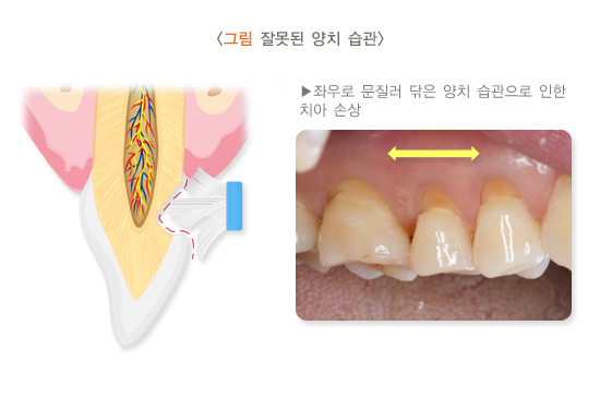 치경부마모증-썸네일