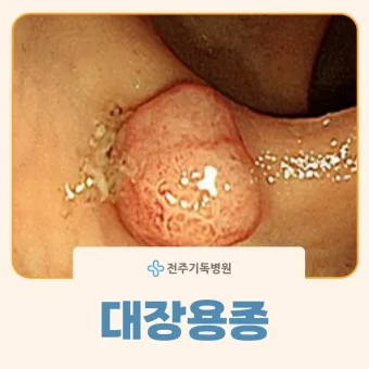 대장내시경 용종제거 후 식사 식단조절_25