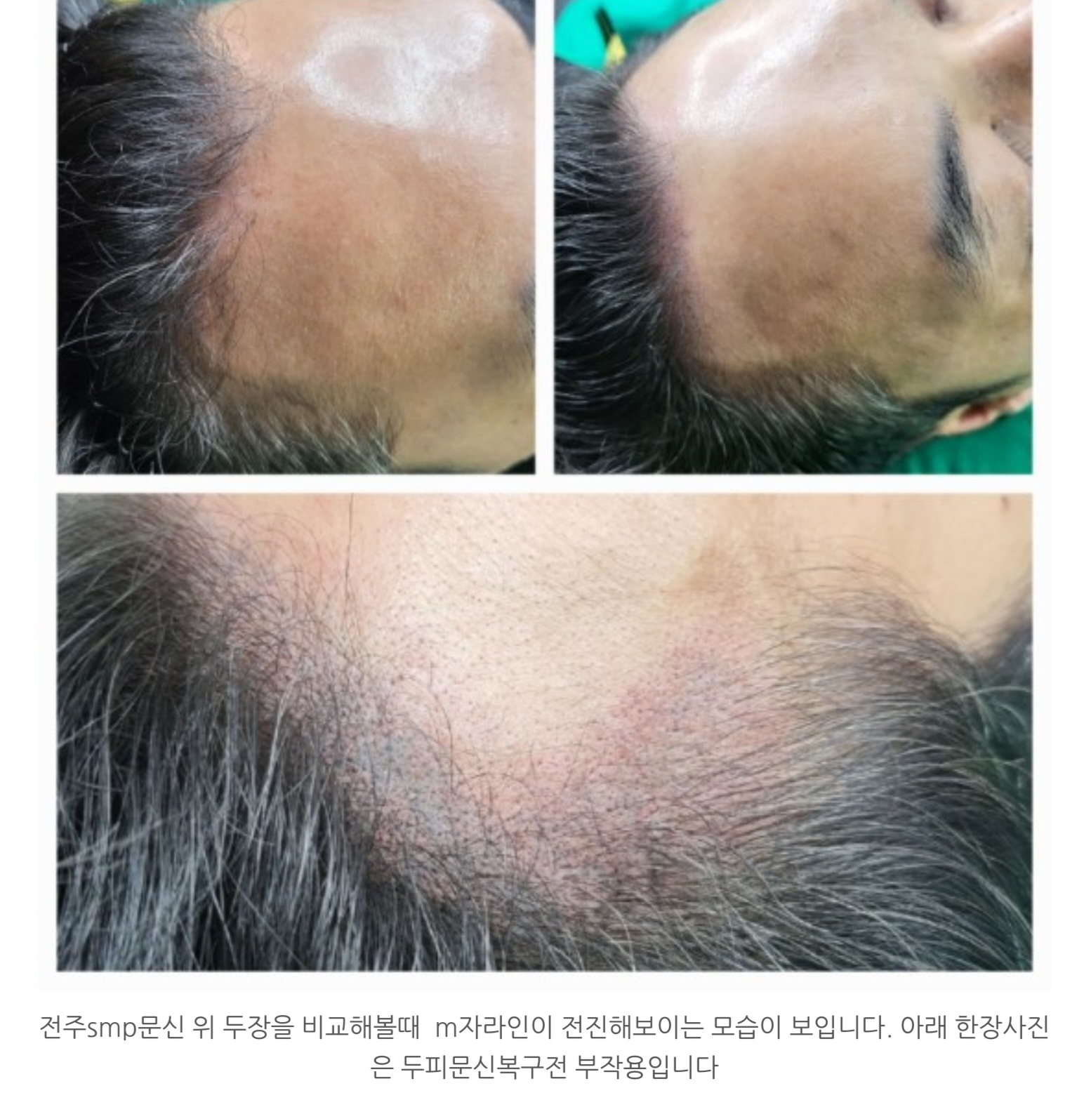  전주 ~ 전북대 두피문신 부작용 복구잘하는곳