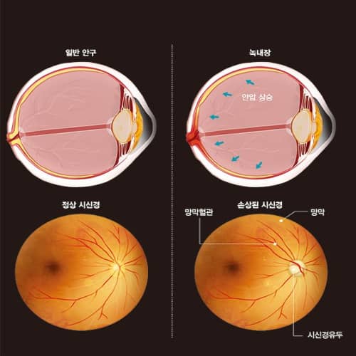 녹내장 썸네일