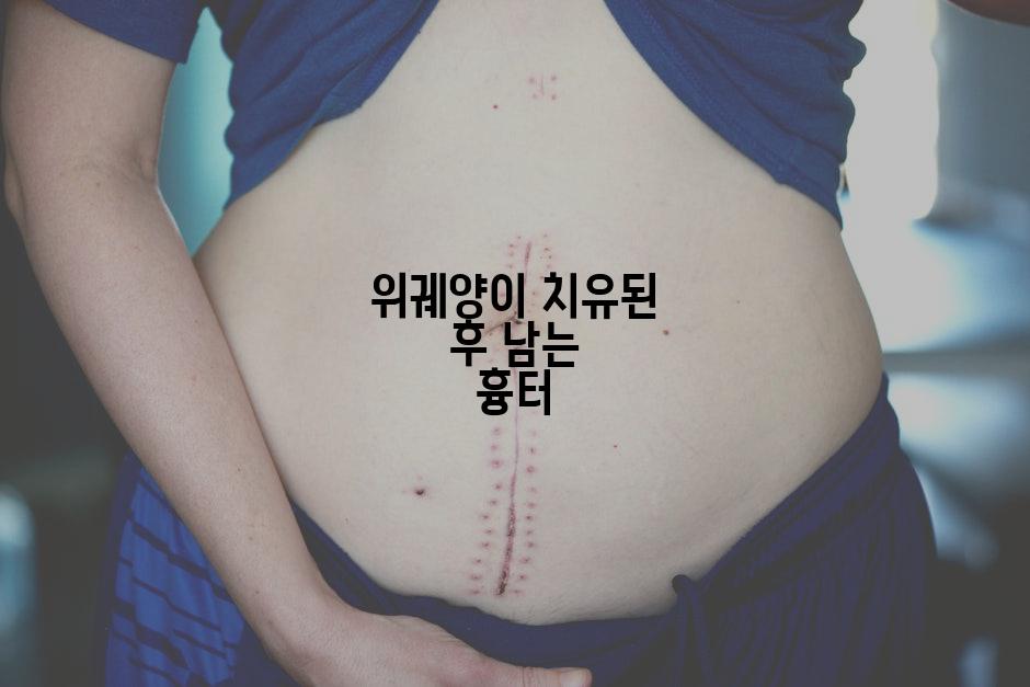 위궤양이 치유된 후 남는 흉터