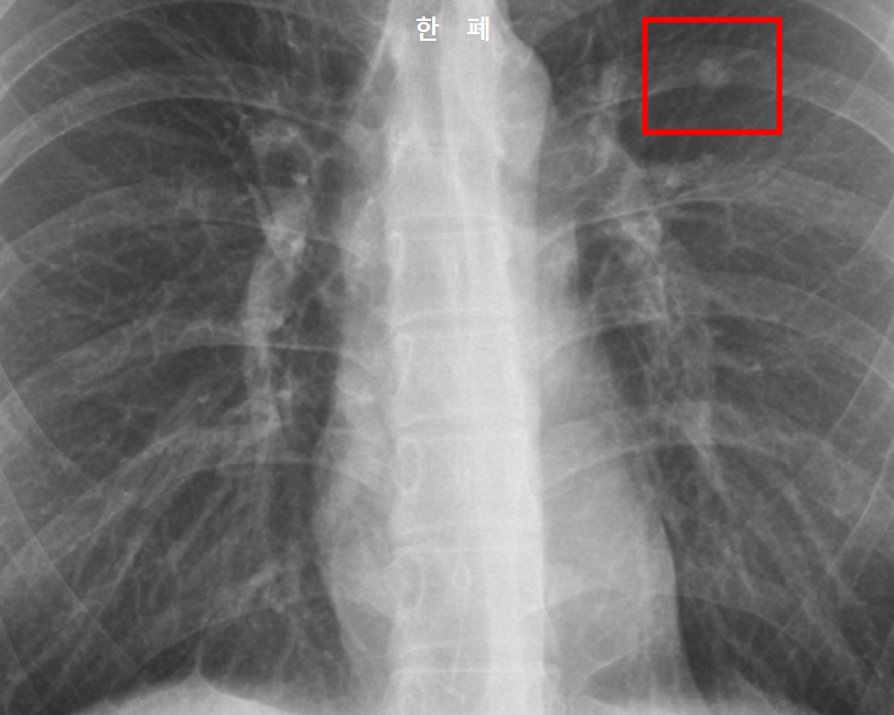 커진 폐결절 X-ray 사진