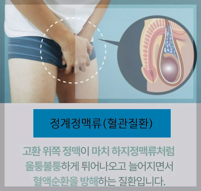 정계 정맥류 설명