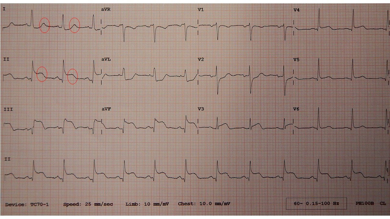 의학용어 MI : STEMI, NSTEMI 알아보기 2