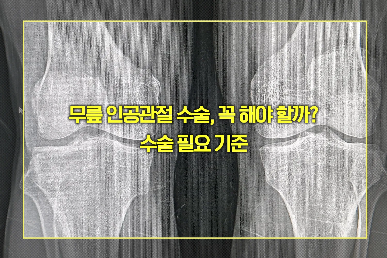 무릎 인공관절 수술 필요 기준