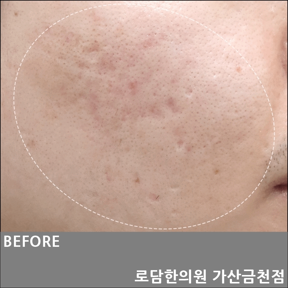  부천 여드름 흉터 롤링형 자국 제거 로담한의원 새살침