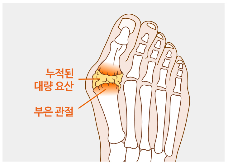 통풍 증상