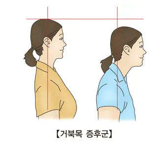 거북목 증상 치료법 스트레칭_8