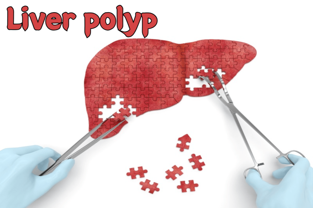 Liver polyp