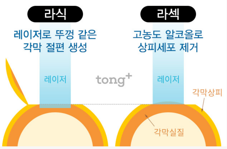 라식 라섹 차이점 부작용