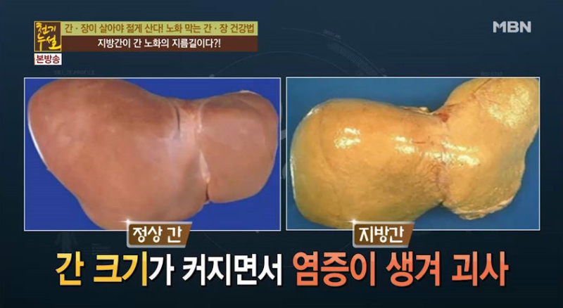  지방간에 좋은 음식 안좋은 음식