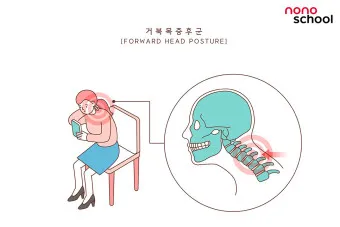 거북목 증상 치료법 스트레칭_5