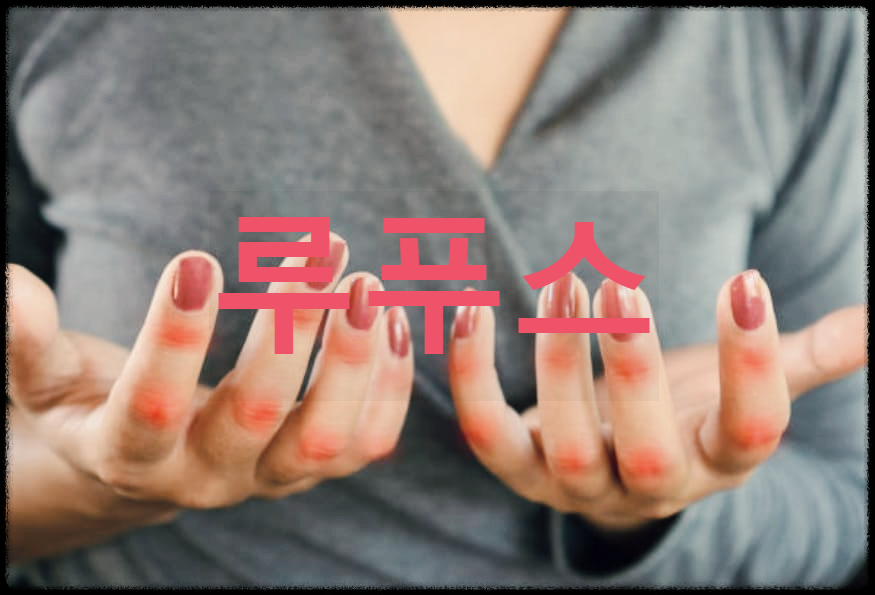  루푸스 : 만성 염증성 자가면역 질환