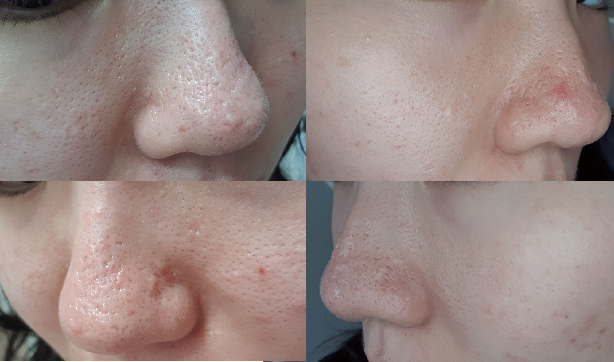 왕십리 피부과 피코 프락셀 레이저 | 마스크 착용으로 커진 코 모공과 여드름 흉터 치료에! 10