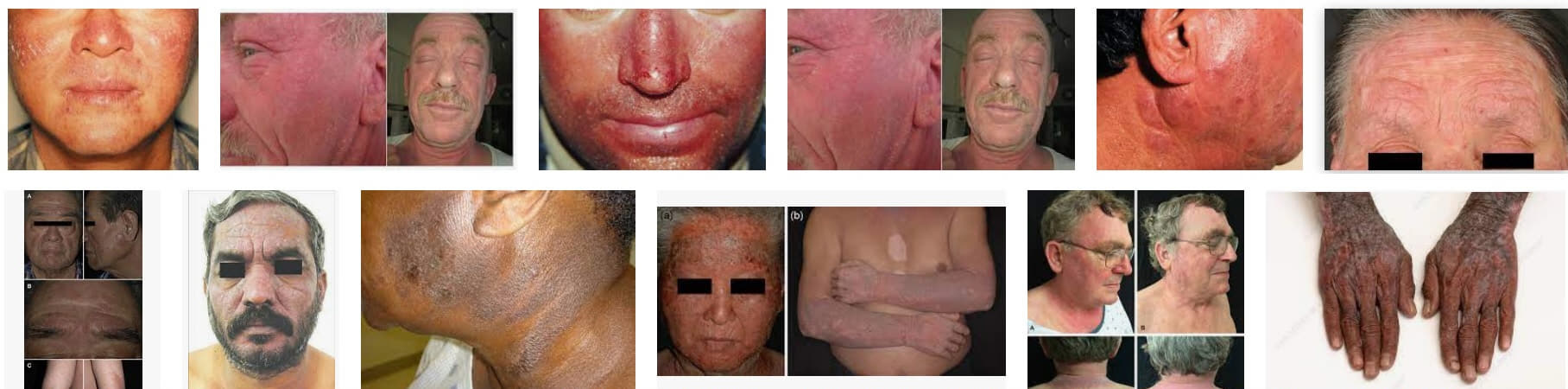 의학용어 actinic dermatitis 뜻 빛피부염, 광선피부염