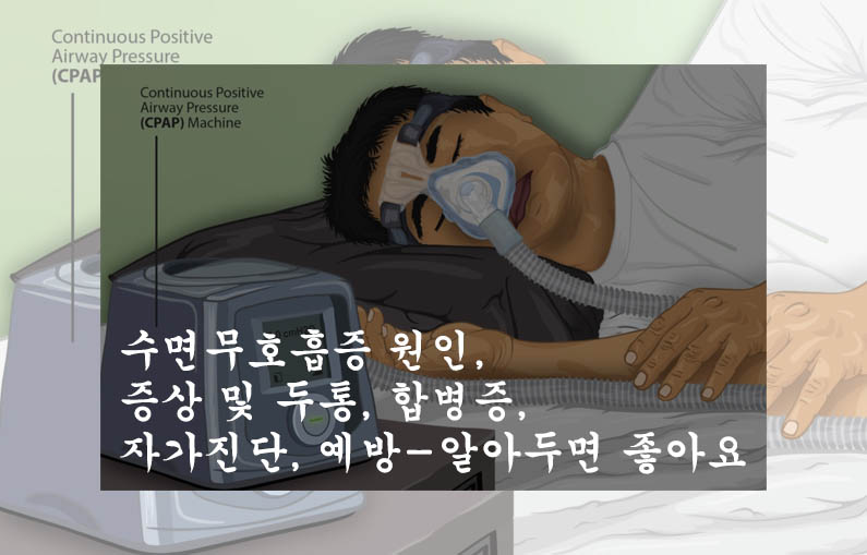  수면무호흡증 원인, 증상 및 두통, 합병증, 자가진단, 예방-알아두면 좋아요