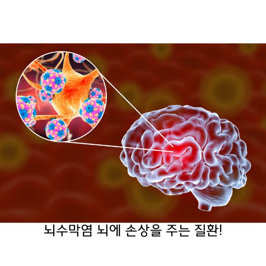  뇌수막염 원인과 증상 그리고 치료방법과 예방